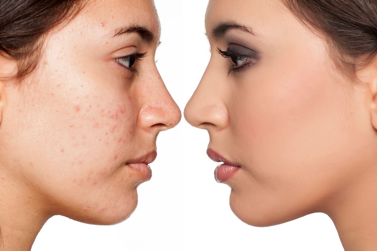 How to Get Rid of Acne with Home Remedies and Natural Supplements